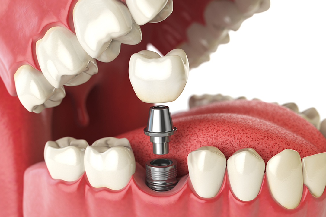 Dental Implants in Saskatoon