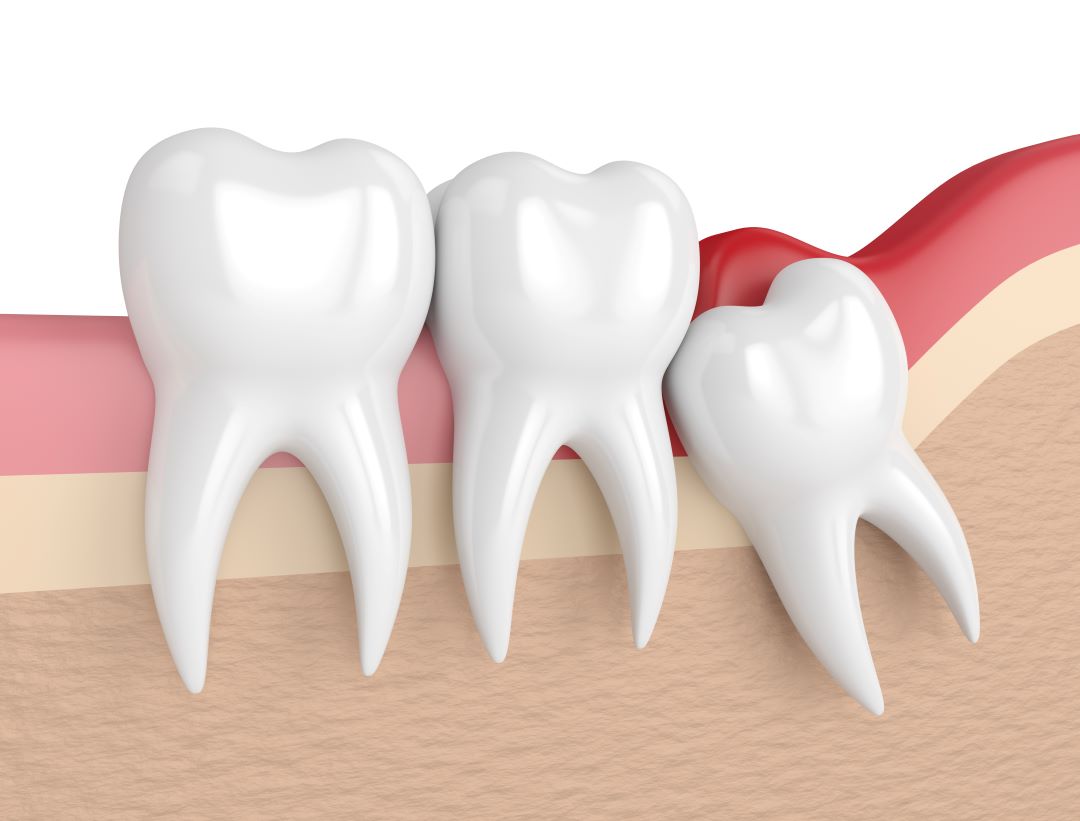 wisdom teeth extraction in saskatoon