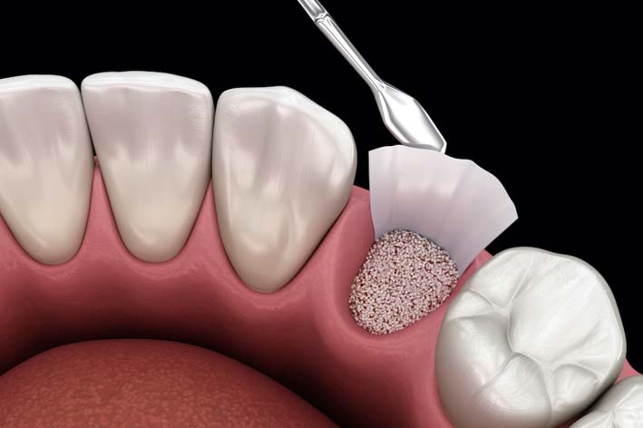 Bone Grafting