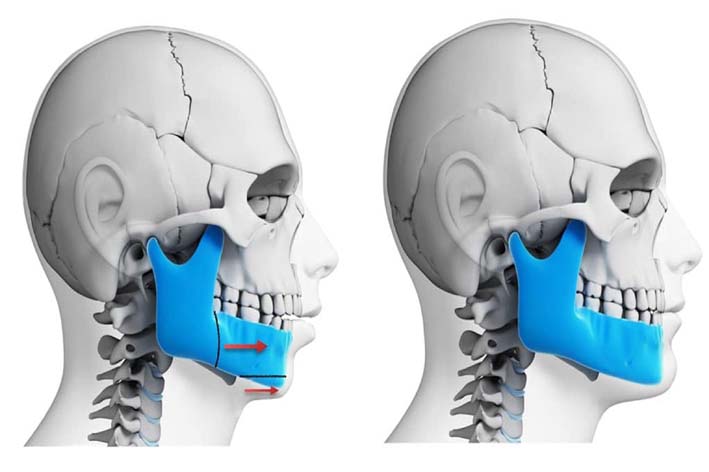 Corrective Jaw Surgery