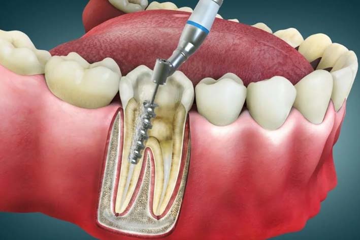 Root Canal Therapy