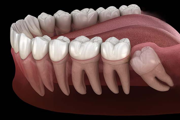 Wisdom Teeth Removal